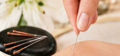 Acupuncture needle being placed