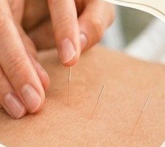 Acupuncture needles on the back