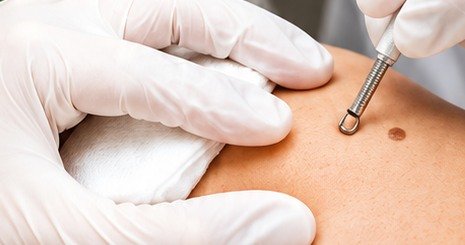 Dermatologist examining a mole